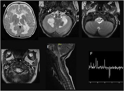 Spinal Cord Involvement in Pediatric-Onset Metabolic Disorders With Mendelian and Mitochondrial Inheritance